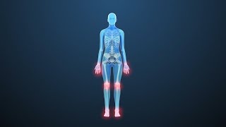 Rheumatoid Arthritis: Treatments for Stiff, Painful Joints