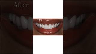 Smile transformation. Smile transformation.