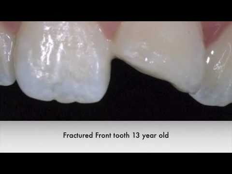 white filling restoration front tooth youtube