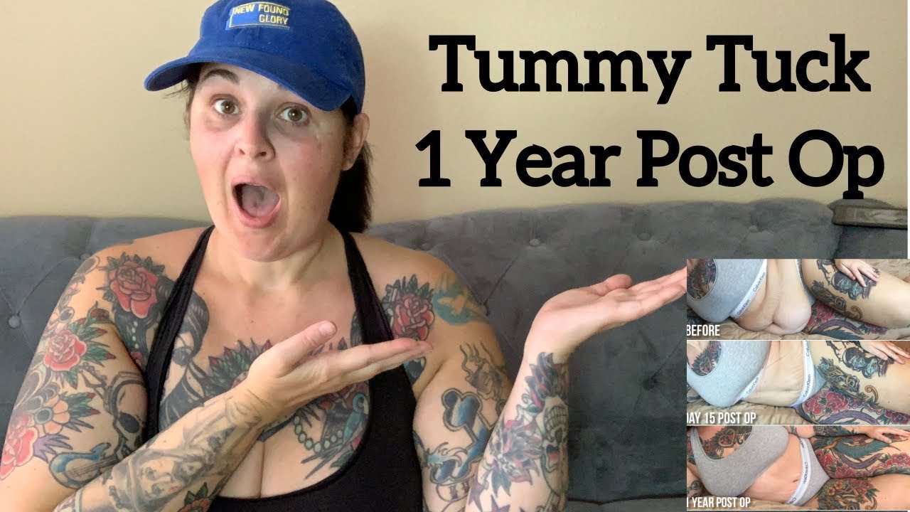 2 months Post Op Tummy Tuck - YouTube