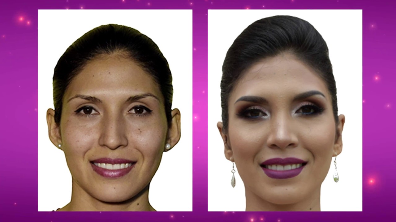 RINOPLASTÍA - OTOPLASTÍA (DR. LUIS BARRENECHEA - SUZIE) - YouTube