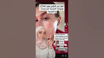 كيف قدرة هيلي بيبر تتخلص من حساسية البشرة 