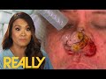 Dr. Lee Transforms This Patient’s Nose By Burning Off The Skin! I Dr. Pimple Popper