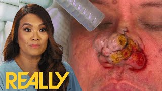 Dr. Lee Transforms This Patient’s Nose By Burning Off The Skin! I Dr. Pimple Popper