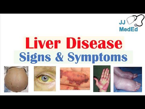 Liver Disease Signs & Symptoms (ex. gynecomastia, bruising) | Hepatic Stigmata