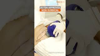 Coolsculpting 65% Off