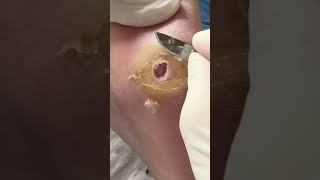 (MUST SEE) Satisfying Ulcer Debridement