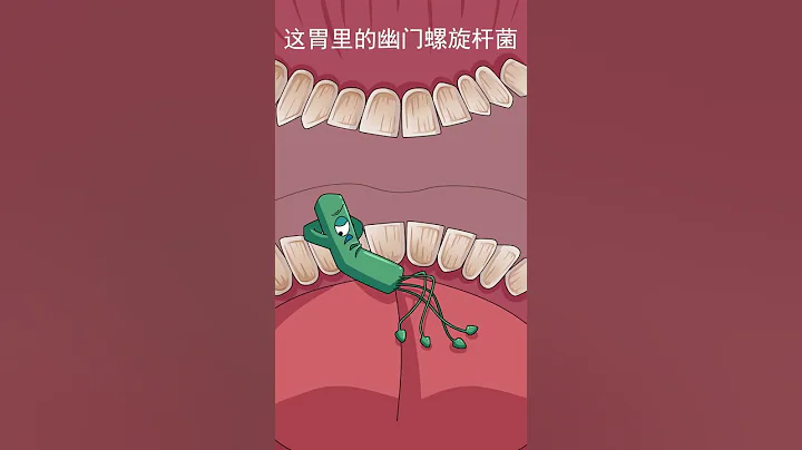 幽門螺旋桿菌感染Helicobacter pylori infection - 天天要聞