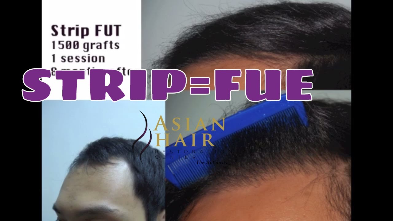 Hair Transplant in the Philippines Manila and Asia. YouTube