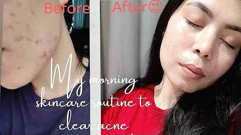 Morning skincare routine to clear acne |Aishwarya ...