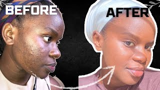 how to get clear skin without spending money *evidence based* no pills, no doctors/ 3 tips