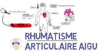 Rhumatisme Articulaire Aigu Raade A À Z