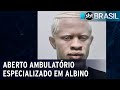 Primeiro ambulatório especializado em atender albinos é aberto em SP | SBT Brasil (03/12/20)