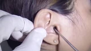 超絶スッキリ。女性の耳からとんでもないサイズの耳垢がとれた動画