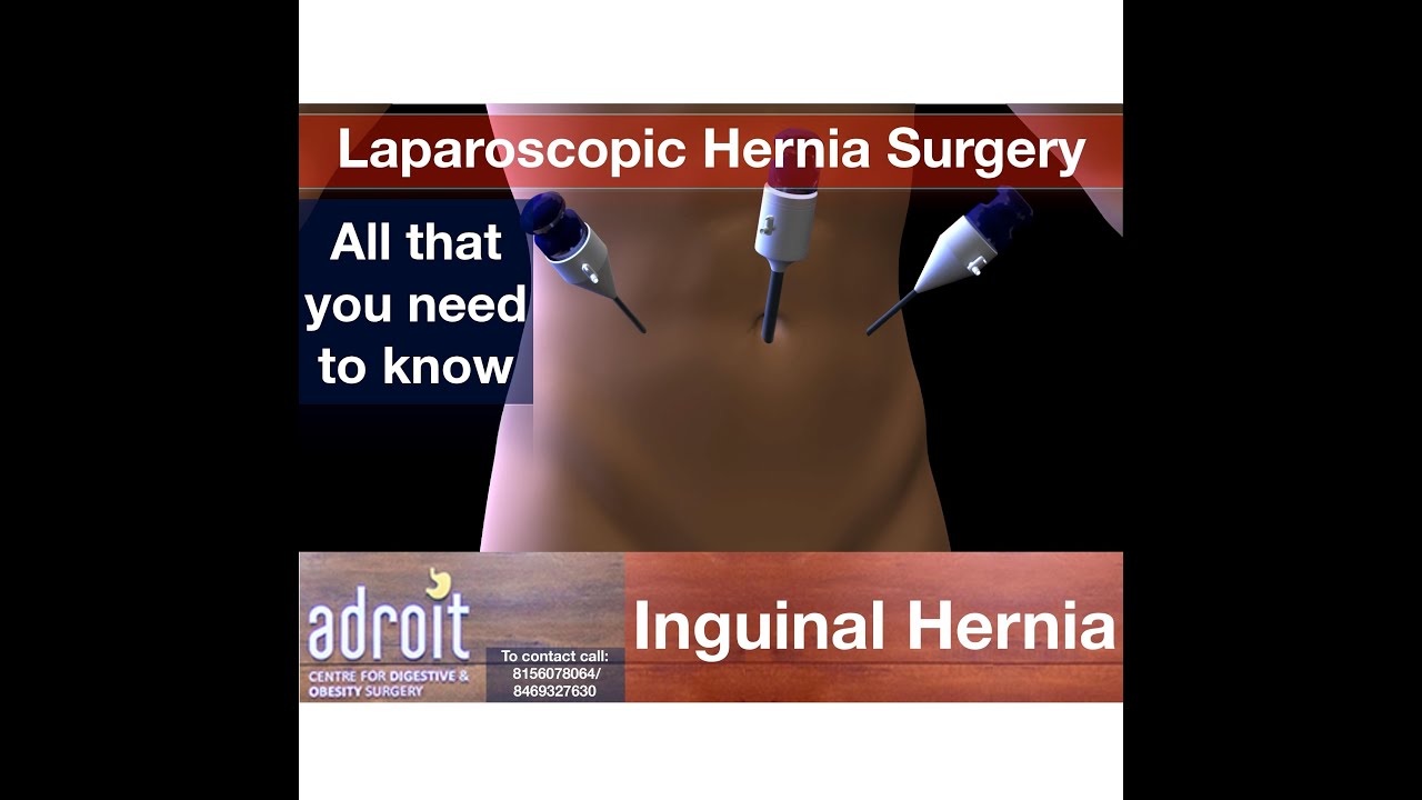 hernia surgery side effects Laparoscopic Inguinal Hernia Surgery Patient Information in English