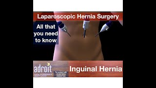 Laparoscopic Inguinal Hernia Surgery Information Best Laparoscopic Inguinal Surgery in Gujarat,India