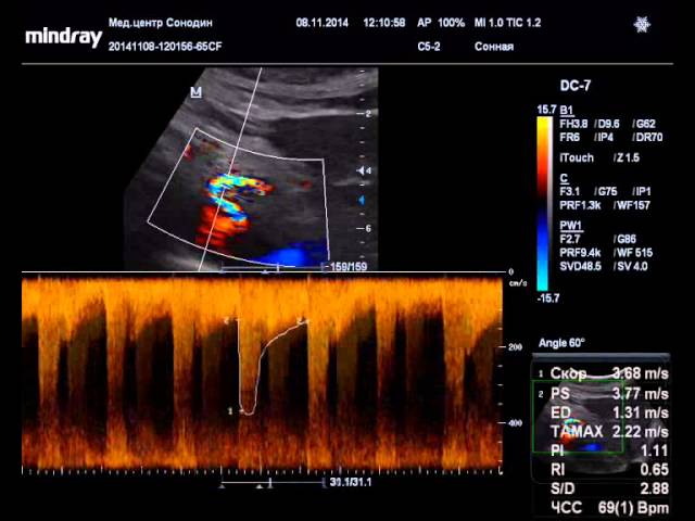 Стеноз чревного ствола