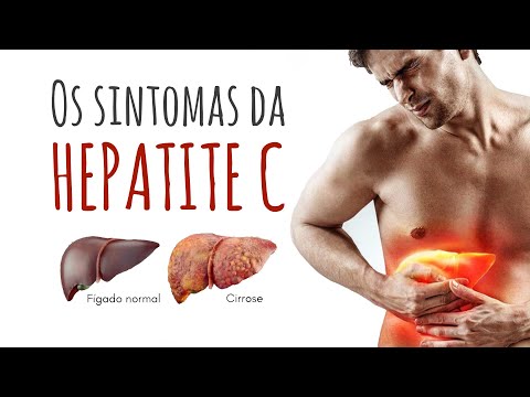 Vídeo: Sintomas E Sinais De Alerta Da Hepatite C