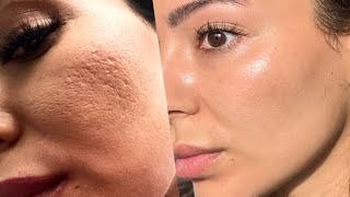 How I Got Rid of My Acne Scars and Large Open Pores screenshot 5