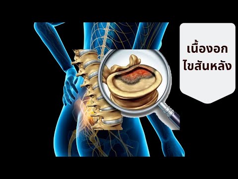 เนื้องอกไขสันหลัง สาเหตุ