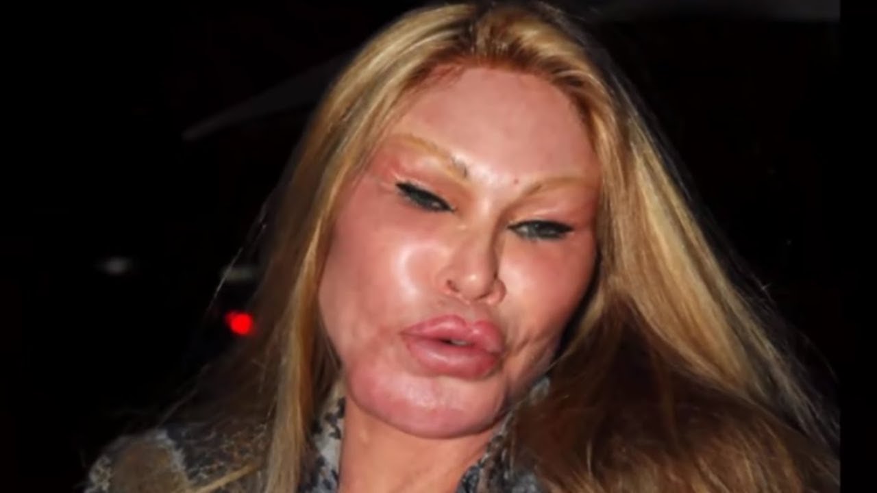 Les Pires Rates De La Chirurgie Esthetique