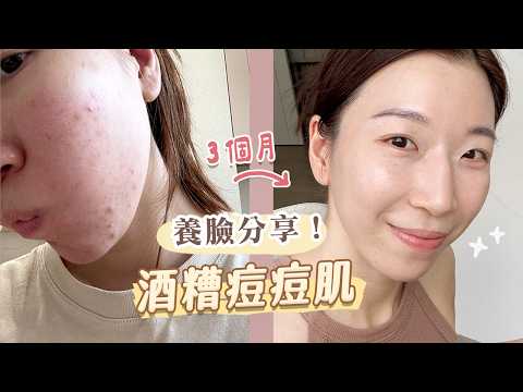 Heal Your Skin in 3 Months! How to Rescue Rosacea and Acne-Prone Skin? Ditch All Skincare Product...