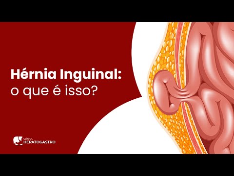 Fiz uma cirurgia de hernia inguinal, será que ainda posso jogar