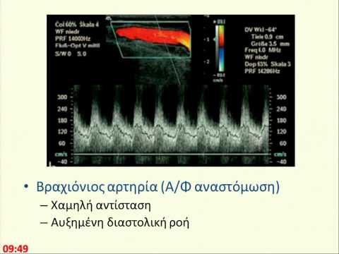 Βίντεο: Ποιος είναι ο στόχος του UF στη αιμοκάθαρση;