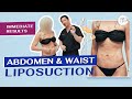 Abdomen & Waist Liposuction | Immediate Results | Minimal Downtime | Artlipo | Expert Dr. Thomas Su