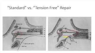 Literature Review: The tension-free hernioplasty (Lichtenstein repair)