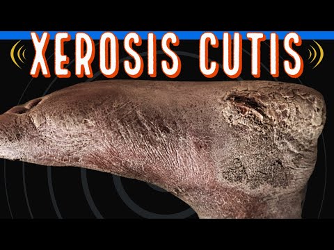 Video: Xerosis Cutis: Årsaker, Symptomer Og Behandlinger