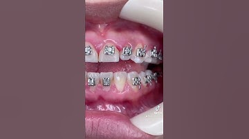 How Braces Brackets are Glued on - A dentist explains the steps #shorts #braces