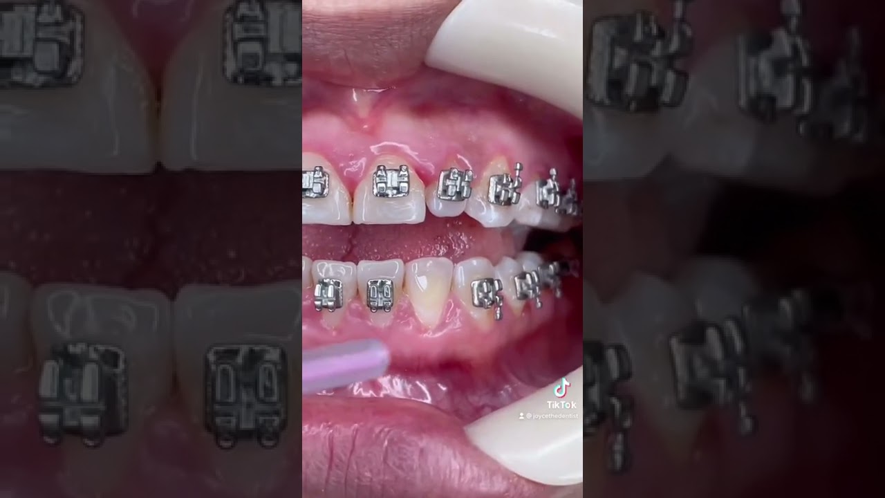 How Braces Brackets are Glued on - A dentist explains the steps 