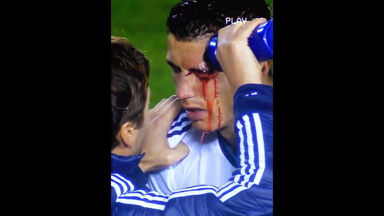 Ronaldo was bleeding but still score