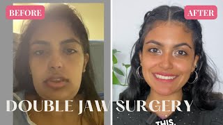 FULL TRANSFORMATION One Year Post-Op | Double Jaw Surgery Experience