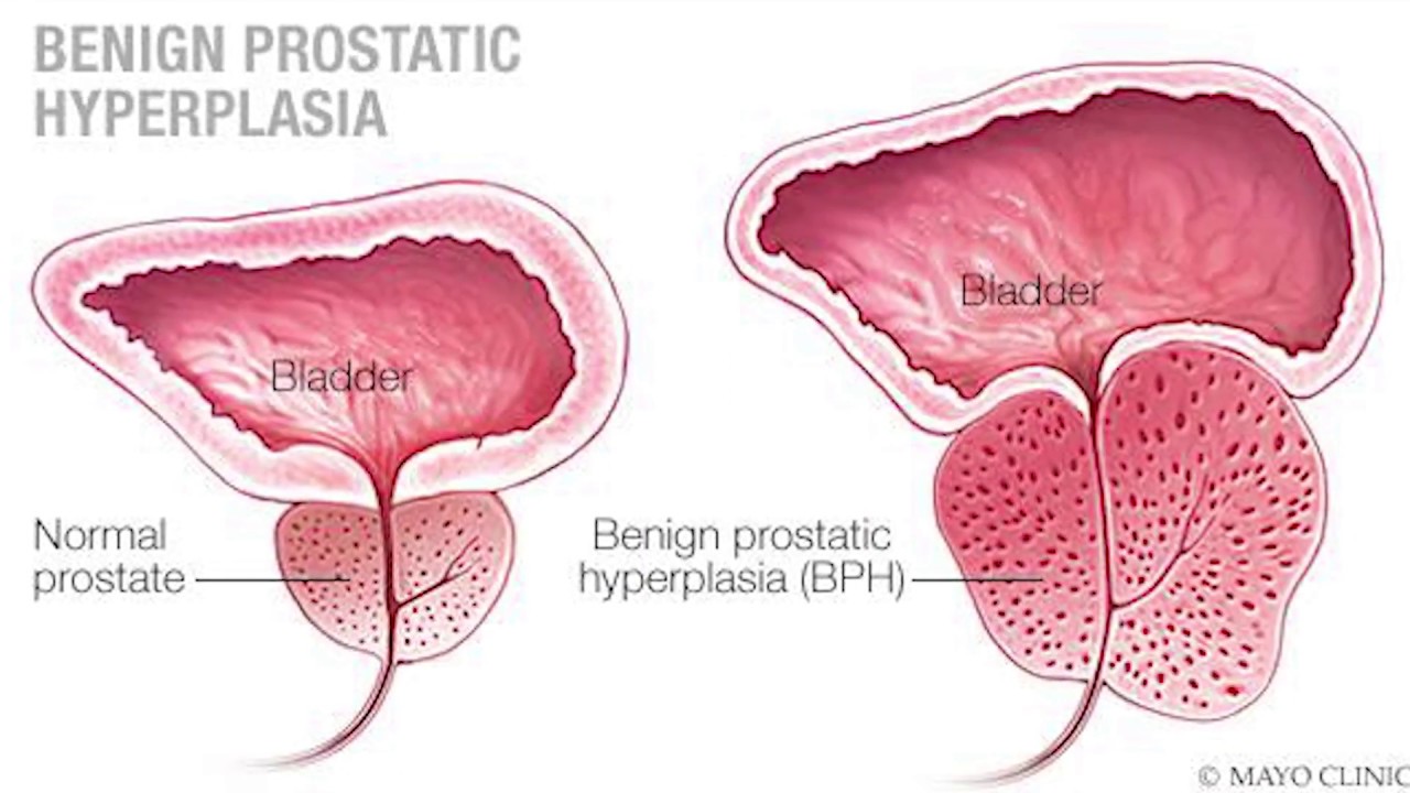 prostata probleme