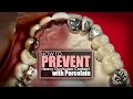 How To Prevent Heavy Occlusion Contact with Porcelain