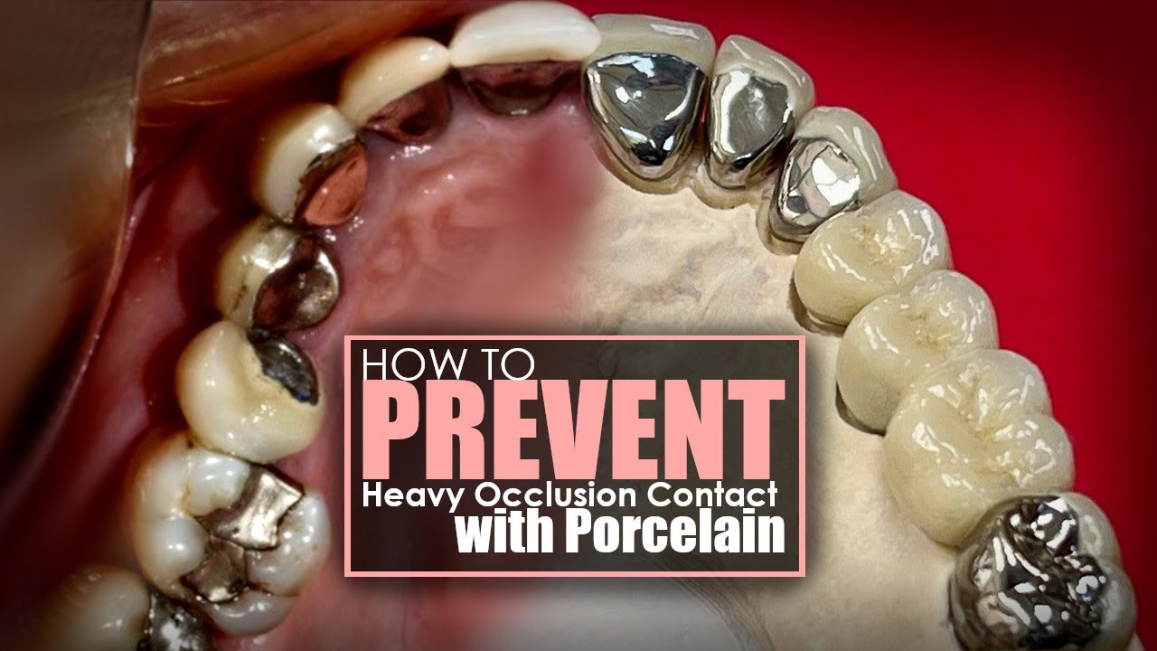 How To Prevent Heavy Occlusion Contact with Porcelain YouTube