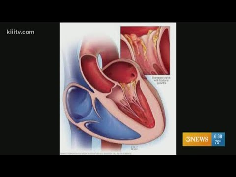 Video: Este endocardita în pericol viața?