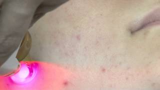 Red Veins Treatment.mp4
