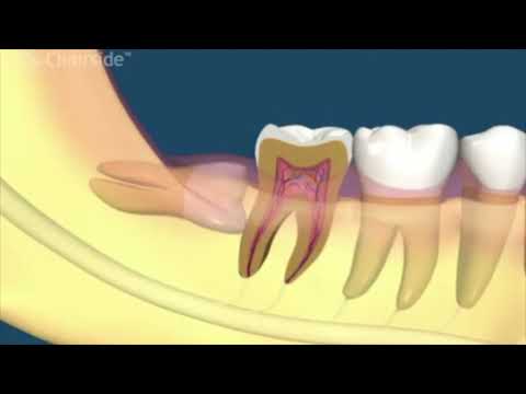 Видео: Как лечить инфицированный зуб мудрости (с иллюстрациями)