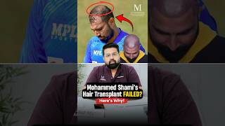 Md Shami's Hair Transplant Failed? Hair Transplant in Raipur