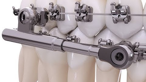 Empower Dual System+Powerscope class II corrector: how to activate it