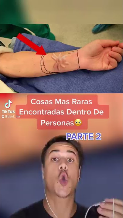 Cosas Mas Raras Encontradas Dentro De Personas 😳Parte 2 #shorts