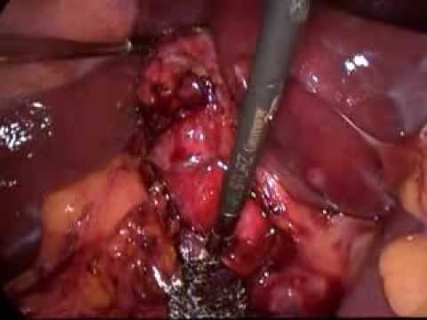 Laparoscopic Cholecystectomy (unedited-39)-Chronic Cholecystitis-very Badly Distorted Neck Anatomy