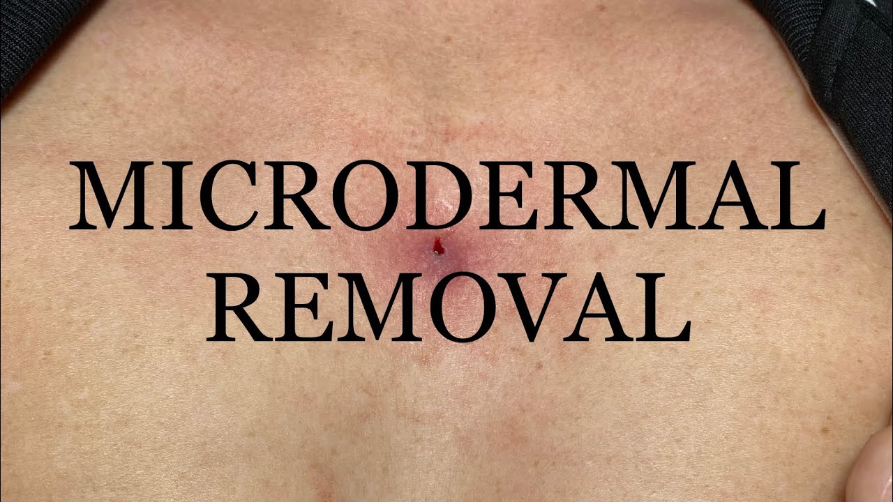 Microdermal anchor piercing removal YouTube