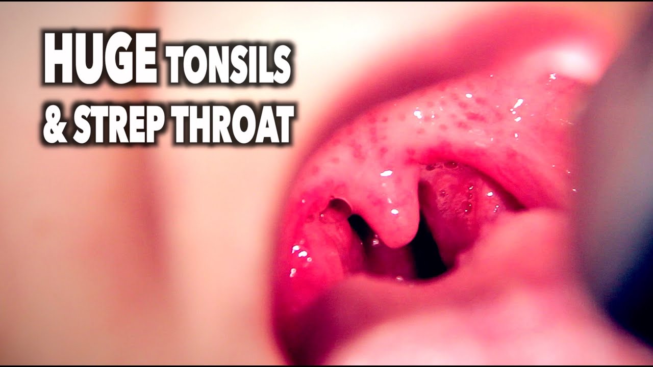 Strep Throat 114