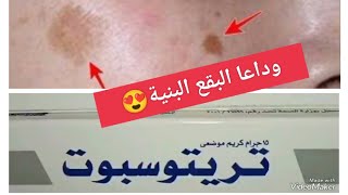 ✅كريمة تريتوسبوت tritospot لإزالة البقع الداكنة البنية شرح طريقة الاستعمال ونصائح ?