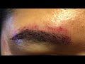 Dallas Asian Male Eyebrow Hair Transplant Immediately After