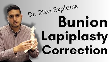 3D Bunion Correction: Lapiplasty Bunion Procedure | Dr. Rizvi Explains